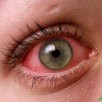pink-eye