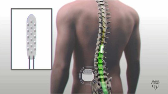 How-Electrical-Stimulation-Helps-Spinal-Cord-Injury-Recovery