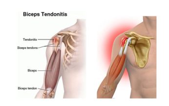 التهاب شدید تاندونهای عضلات دوسر بازو