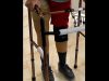 ویدئو| تعبیه پای مصنوعی برای معلولان جنگ غزه در بیمارستان!